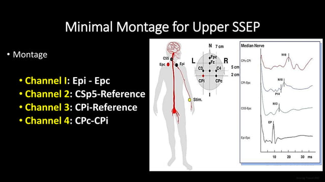 Upper Extremity Somatosensory Evoked Potential (Upper SSEP) | PPTX ...