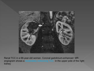 Upper tract TCC PPT