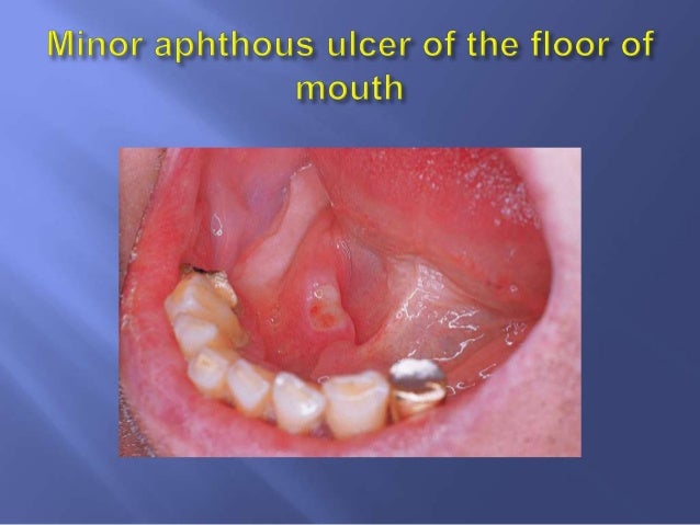 Primary Oral Ulcerative Lesions New