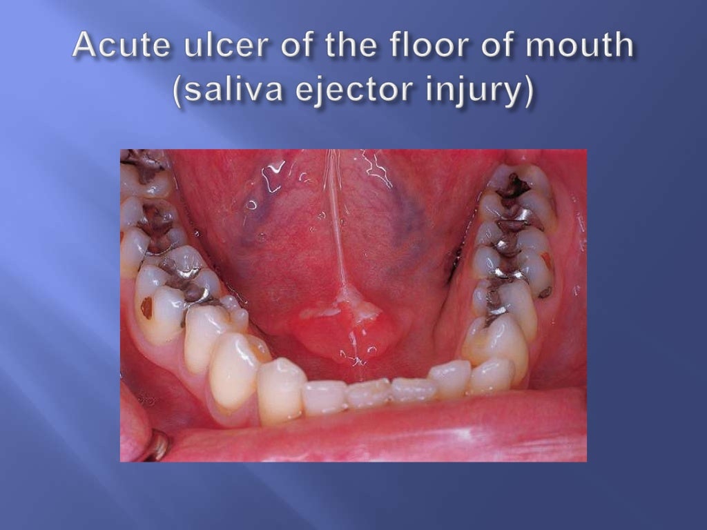 Primary oral ulcerative lesions new