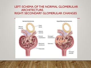 LEFT: SCHEMA OF THE NORMAL GLOMERULAR
ARCHITECTURE.
RIGHT: SECONDARY GLOMERULAR CHANGES
 