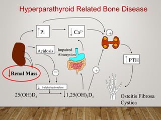 PTH
Pi Ca2+
Renal Mass
25(OH)D3 1,25(OH)2D3
1-alpha-hydroxylase1-alpha-hydroxylase
+
Acidosis
+
Hyperparathyroid Related Bone Disease
Impaired
Absorption
Osteitis Fibrosa
Cystica
 