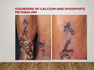 DISORDERS OF CALCIUM AND PHOSPHATE
METABOLISM
Other complications of abnormal mineral
metabolism:
• Calciphylaxis (calcific uremic arteriolopathy)
• Other etiologies
• use of oral calcium as a phosphate binder
• Warfarin
 