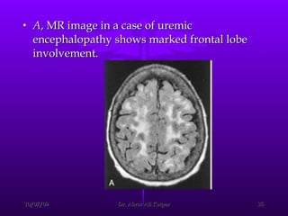 A , MR image in a case of uremic encephalopathy shows marked frontal lobe involvement.  