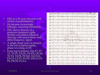 EEG in a 56-year-old man with uremic encephalopathy.  He became increasingly lethargic, requiring intubation.  EEG shows absence of a posterior dominant alpha rhythm and diffuse bilateral slowing with mixed theta- and delta-frequency signal.  A single sharp wave is present in the left occipital region, phase reversing at O1.  From top to bottom: Fp1-F7, F7-T3, T3-T5, T5-O1, O1-O2, O2-T6, T6-T4, T4-F8, F8-Fp2, Fp2-Fp1, F3-C3, C3-P3, P3-O1, F4-C4, C4-P4, P4-O2, Fz-Cz. 