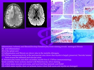 Inflammatory ischemia and fibrosisDevelop.Hematoxylin/eosin staining reveals  meningeal fibrosis  and inflammation  ( B ) in the spinal cord.  ( C ) Inflammation and fibrosis are shown also in the medulla oblongata.  ( D ) CNPase immunoreactivity at the perivascular area shows that myelin is largely preserved. Necrotic lesions form around the inflamed perivascular areas  ( E , hematoxylin/eosin) and show secondary myelin loss ( F , CNPase immunostaining).  Serial cerebellar brain sections stained with Bielschowsky silver staining  ( G ), which stains neurons and axons, and luxol fast blue/periodic acid Schiff  ( H ), which stains myelin, show an ischemic lesion where both axons and myelin are damaged.  