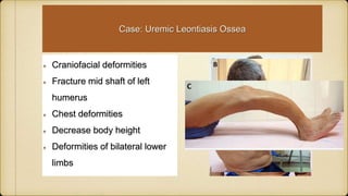 Craniofacial deformities
Fracture mid shaft of left
humerus
Chest deformities
Decrease body height
Deformities of bilateral lower
limbs
Case: Uremic Leontiasis Ossea
 