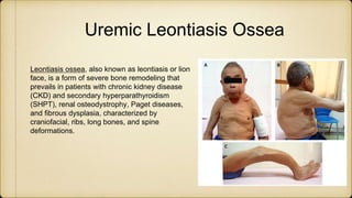 Uremic Leontiaisis Ossea ppt