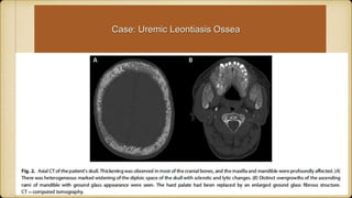 Case: Uremic Leontiasis Ossea
Case: Uremic Leontiasis Ossea
 