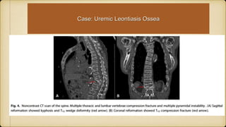 Case: Uremic Leontiasis Ossea
 