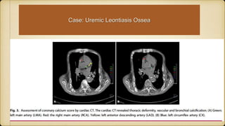 Case: Uremic Leontiasis Ossea
 