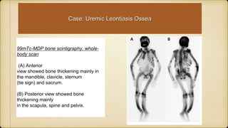 99mTc-MDP bone scintigraphy, whole-
body scan
(A) Anterior
view showed bone thickening mainly in
the mandible, clavicle, sternum
(tie sign) and sacrum.
(B) Posterior view showed bone
thickening mainly
in the scapula, spine and pelvis.
Case: Uremic Leontiasis Ossea
 