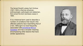 The famed Rudolf Ludwig Carl Virchow
(1821-1902) a German physician,
anthropologist, pathologist and statesman,
first coined the term leontiasis ossea in
1864.
It is a historical term used to describe a
number of conditions that result in the
affected patient's face resembling that of
a lion. Although it is most frequently
associated withcraniofacial fibrous
dysplasia and has a broader meaning
encompassing other lesions that have
similar appearance.
 