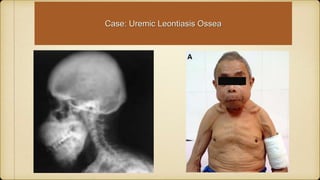 Case: Uremic Leontiasis Ossea
 