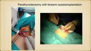 Parathyroidectomy with forearm autotransplantation
 