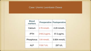 Case: Uremic Leontiasis Ossea
Blood
markers
Preoperative Postoperative
Calcium 2.78 mmol/L 2.20 mmol/L
iPTH 2183.2 pg/mL 57.2 pg/mL
Phosphorus 1.64 mmol/L 0.904 mmol/L
ALP 1138.7 U/L 297 U/L
 