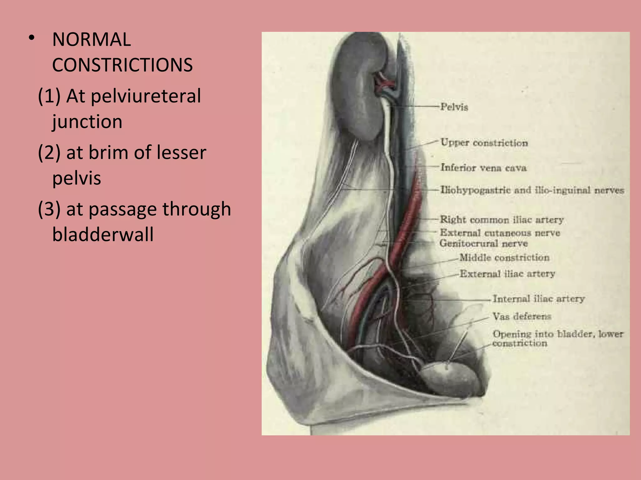NORMAL CONSTRICTIONS (1) At pelviureteral junction (2) at brim of lesser pelvis (3) at passage through bladderwall 