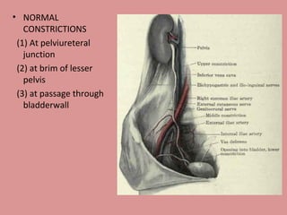 NORMAL CONSTRICTIONS (1) At pelviureteral junction (2) at brim of lesser pelvis (3) at passage through bladderwall 
