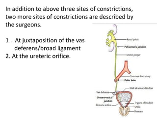 In addition to above three sites of constrictions,
two more sites of constrictions are described by
the surgeons.
1 . At juxtaposition of the vas
deferens/broad ligament
2. At the ureteric orifice.
 