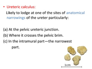 • Ureteric calculus:
Likely to lodge at one of the sites of anatomical
narrowings of the ureter particularly:
(a) At the pelvic ureteric junction.
(b) Where it crosses the pelvic brim.
(c) In the intramural part—the narrowest
part.
 