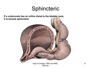 ureterocele | PDF