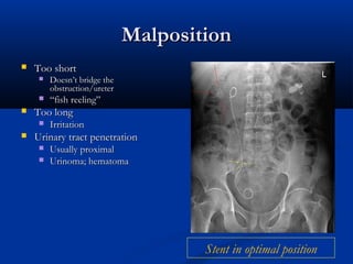 Malposition


Too short






Doesn’t bridge the
obstruction/ureter

“fish reeling”

Too long




Irritation

Urinary tract penetration



Usually proximal
Urinoma; hematoma

Stent in optimal position

 