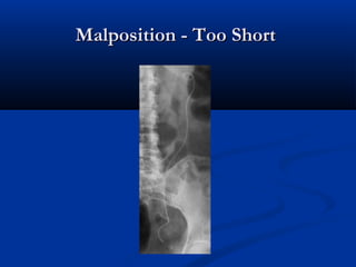 Malposition - Too Short

 