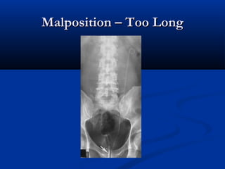 Malposition – Too Long

 