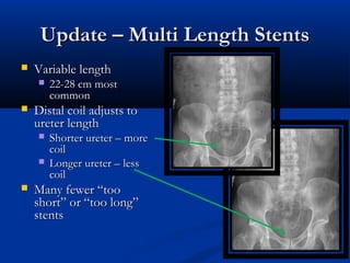 Update – Multi Length Stents


Variable length




Distal coil adjusts to
ureter length





22-28 cm most
common
Shorter ureter – more
coil
Longer ureter – less
coil

Many fewer “too
short” or “too long”
stents

 