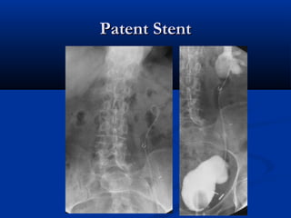 Patent Stent

 