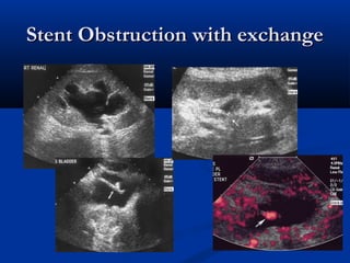 Stent Obstruction with exchange

 