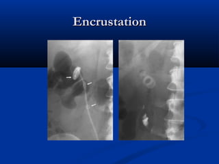 Encrustation

 