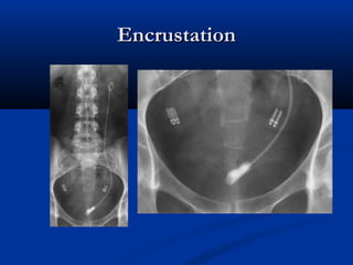 Encrustation

 