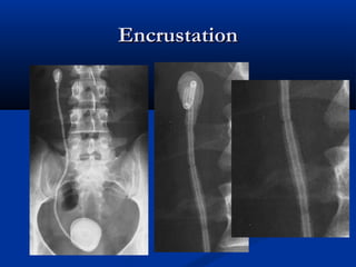 Encrustation

 