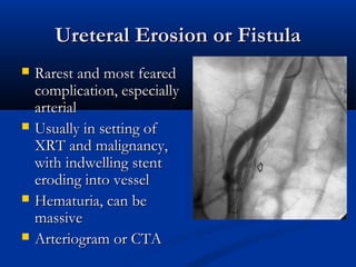 Ureteral Erosion or Fistula







Rarest and most feared
complication, especially
arterial
Usually in setting of
XRT and malignancy,
with indwelling stent
eroding into vessel
Hematuria, can be
massive
Arteriogram or CTA

 