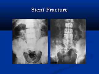 Stent Fracture

 