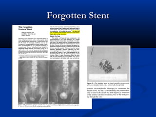 Forgotten Stent

 