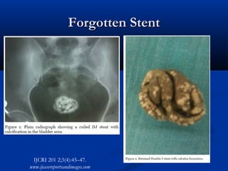 Forgotten Stent

IJCRI 201 2;3(4):45–47.
www.ijcasereportsandimages.com

 