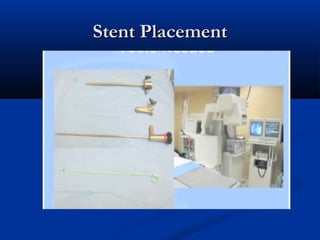 Stent Placement

 