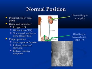 Normal Position



Proximal coil in renal
pelvis
Distal coil in bladder






In upper 1/4
Within 5cm of UVJ
Not beyond midline or
along bladder base

Proper position …




Assures proper function
Reduces chance of
migration
Reduces irritative
symptoms

Proximal loop in
renal pelvis

Distal loop in
bladder, best in
upper 1/4

 