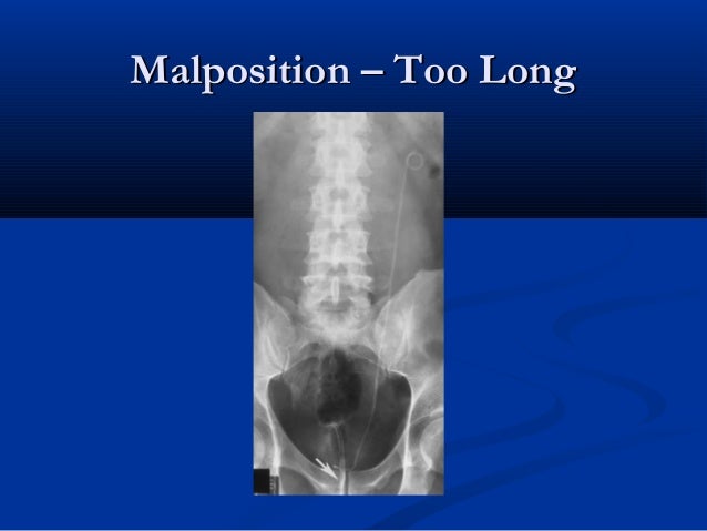 Malposition Too Long 14 Update Multi Length Stents Malposition Too Long 14 Update Multi Length Stents