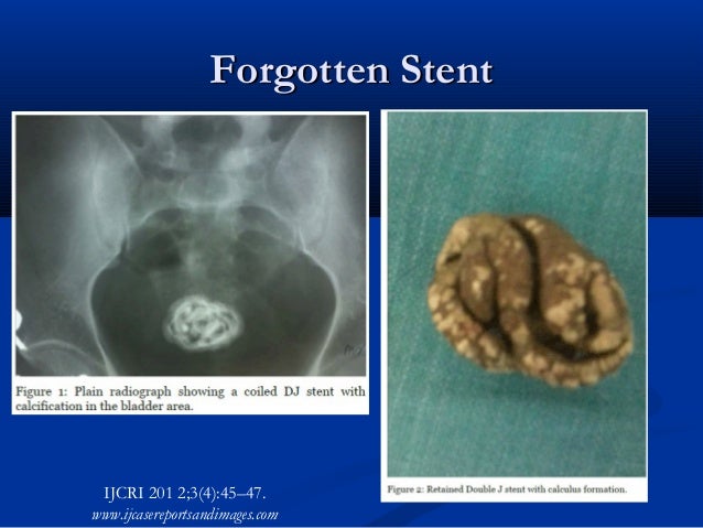 Ureteral Stents For The Dx Radiologist ureteral-stents-for-the-dx-radiologist