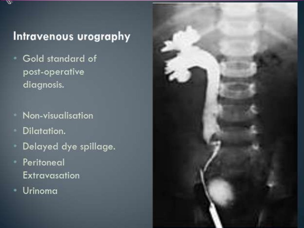 Ureter Anatomy Injury N Diversion