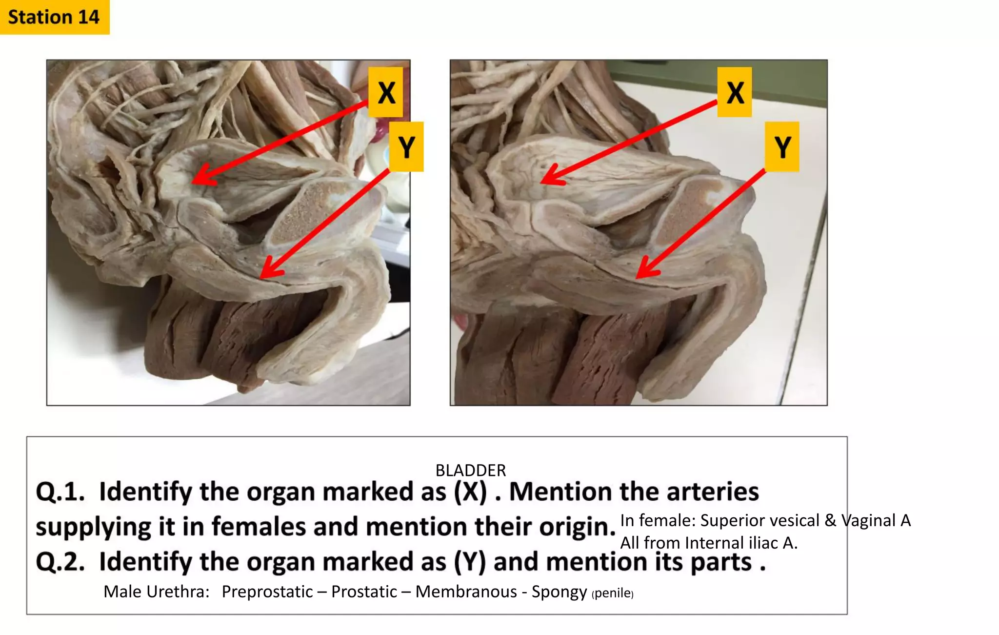 In female: Superior vesical & Vaginal A
All from Internal iliac A.
BLADDER
Male Urethra: Preprostatic – Prostatic – Membranous - Spongy (penile)
 