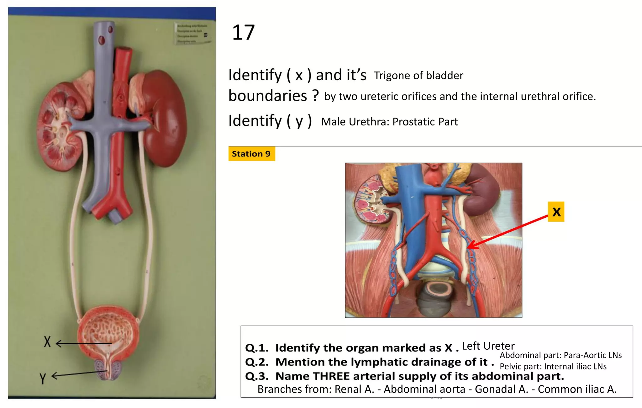 by two ureteric orifices and the internal urethral orifice.
Trigone of bladder
Male Urethra: Prostatic Part
Left Ureter
Abdominal part: Para-Aortic LNs
Pelvic part: Internal iliac LNs
Branches from: Renal A. - Abdominal aorta - Gonadal A. - Common iliac A.
 