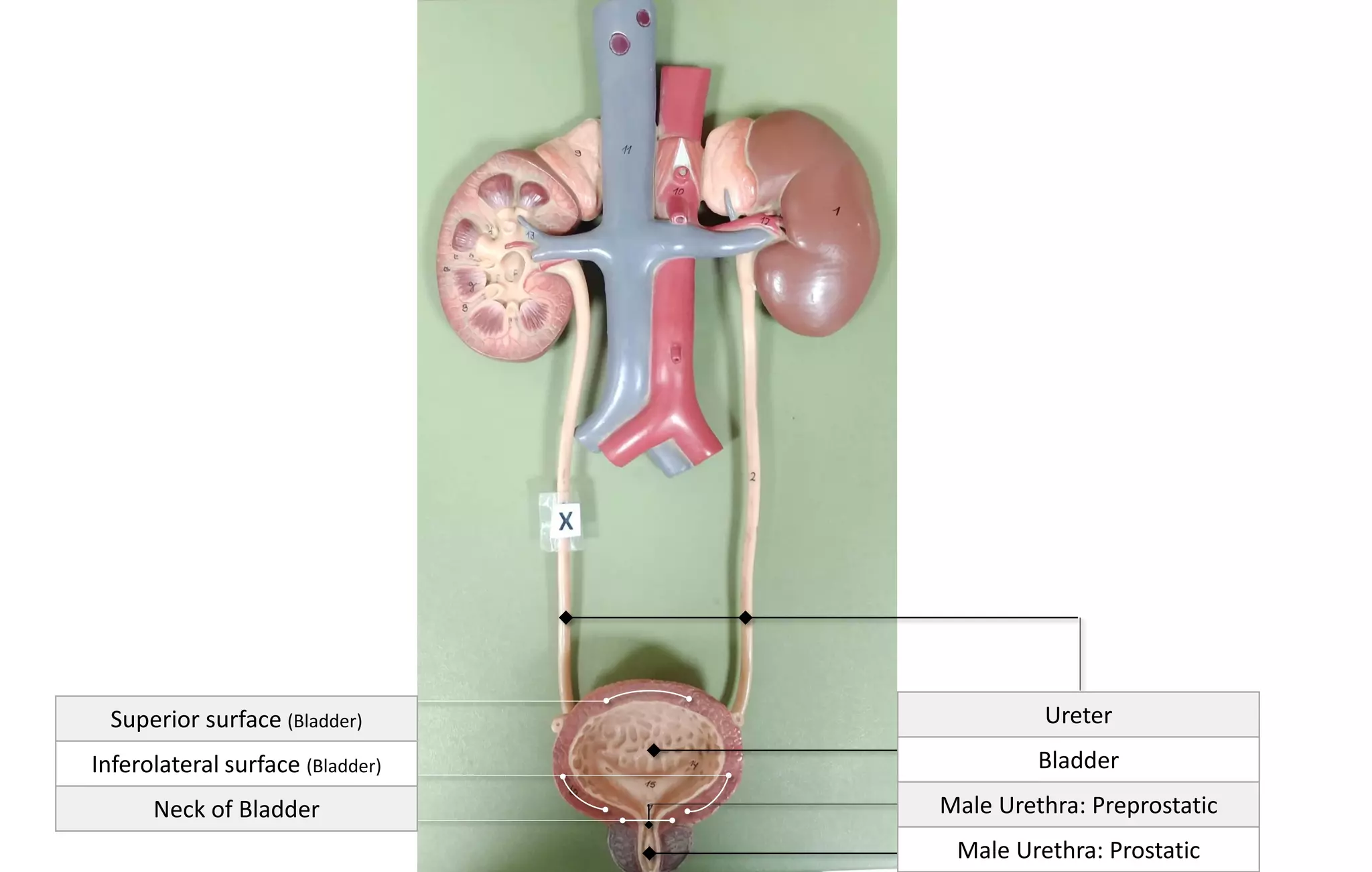 Ureter
Bladder
Male Urethra: Preprostatic
Male Urethra: Prostatic
Superior surface (Bladder)
Inferolateral surface (Bladder)
Neck of Bladder
 