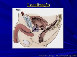 Localização Campbell’s Urology – 9th Edition; vol. 4; p. 3389. 