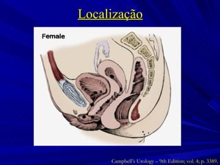 Localização Campbell’s Urology – 9th Edition; vol. 4; p. 3389. 