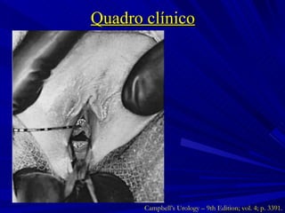 Quadro clínico Campbell’s Urology – 9th Edition; vol. 4; p. 3391. 