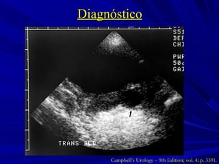 Diagnóstico Campbell’s Urology – 9th Edition; vol. 4; p. 3391. 